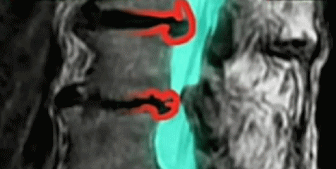 腰椎椎間板ヘルニア手術が必要と診断された方のMRI画像1　福岡 太宰府【腰痛専門】こしの鍼灸整骨院、腰椎椎間板ヘルニア､坐骨神経痛の治療